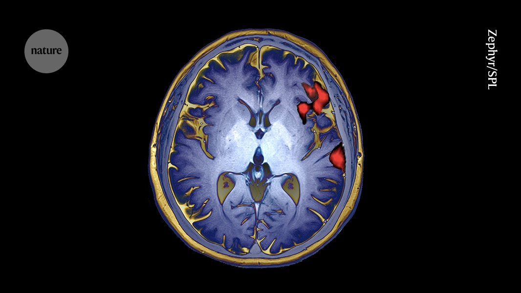 First ‘bilingual’ brain-reading device decodes Spanish and English words