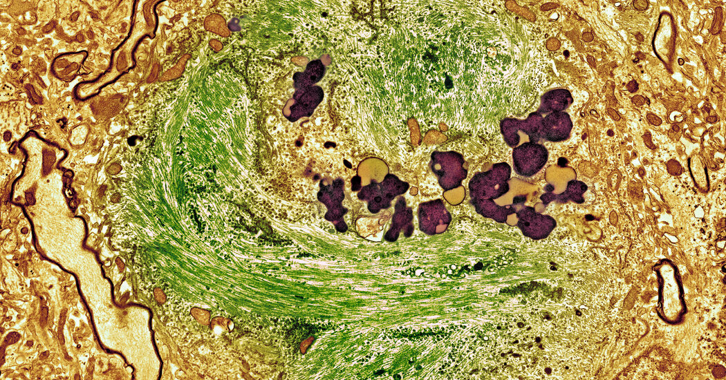 A Blood Test Accurately Diagnosed Alzheimer’s 90% of the Time, Study Finds